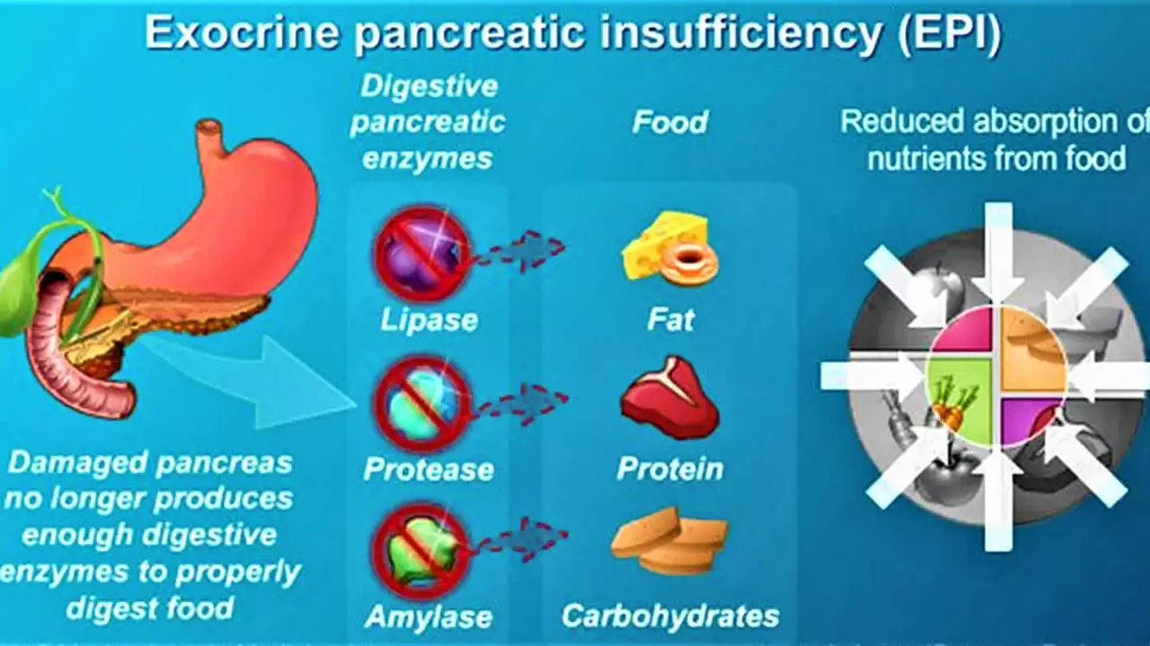 The Role of Diet and Nutrition in Pancreatic Cancer Prevention
